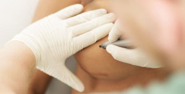 Gesundheitsrisiko bei Brustimplantaten