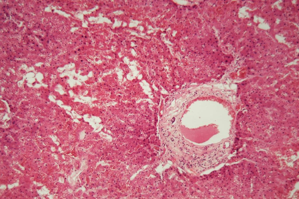 Amyloidose: Eine unheilbare Krankheit mit vielen Gesichtern